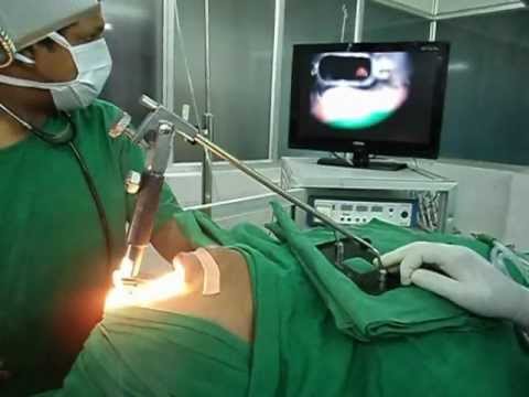 Microlaryngoscopy in Jubilee Hospital Trivandrum_Contd