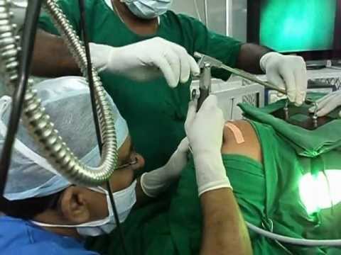 Microlaryngoscopy Procedure.