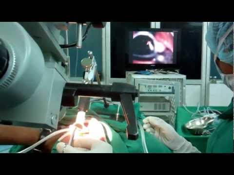 Microlaryngoscopy Procedure Using Microdebrider