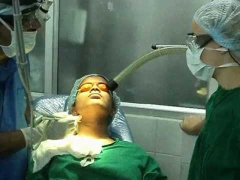 Moles on Face and Neck removal by Laser
