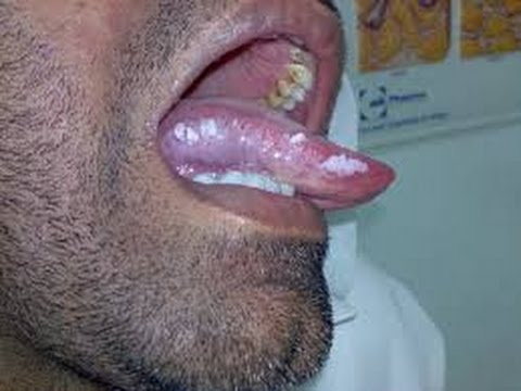 Mouth Cancer-White Patches-Removal By Laser