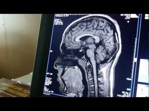 MRI Scan:Diagnosis Sleep Apnea