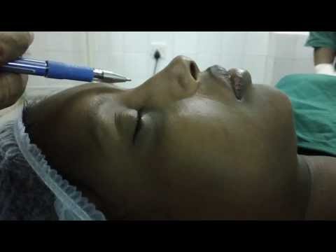 Nasal Aesthetic-An Ideal Nose for a Dravidian Women