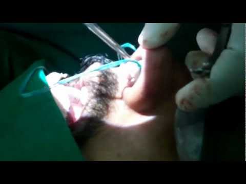 Nasal Airway in Sleep Apnea Surgery