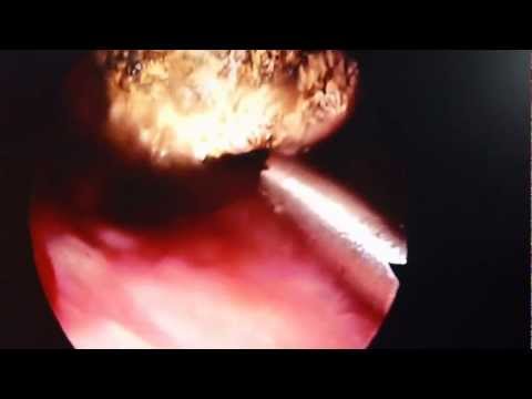 Nasal Allergy:Laser Treatment (Trivandrum)