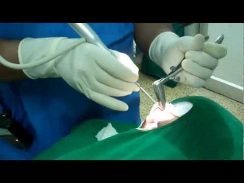 Nasal Allergy Treated by Laser for Jasmine