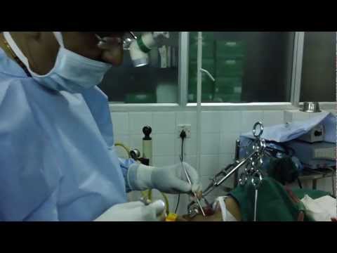 Nasal Blockage,Adenoid and Dental Braces