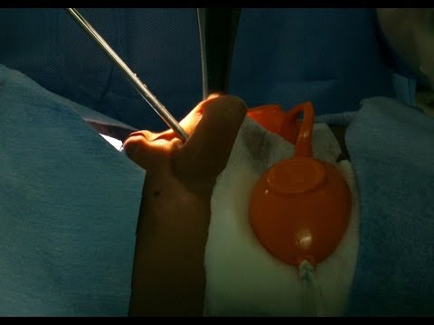 Nasal Blockage and Snoring- Cure by Laser