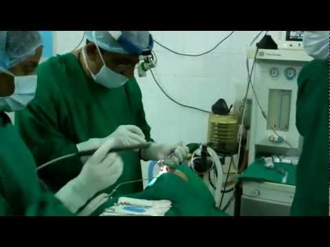 Nasal Blockage:Nasal Turbinate Reduction:SMD