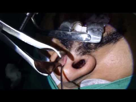 Nasal Blockage Treated in Snoring and Sleep Apnea