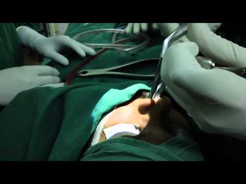 Nasal Bone Fracture-Closed Reduction