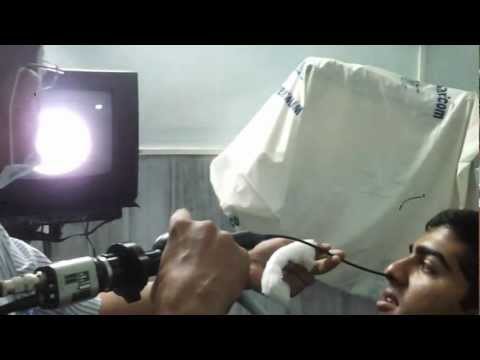 Nasal Endoscopy In Snoring And Sleep Apnea Patient
