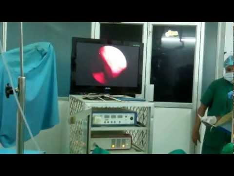 Nasal Polyp: Microdebrider Surgery in India