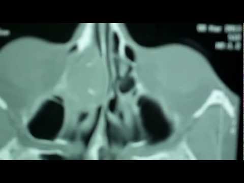 Nasal Polyp or Tumor?