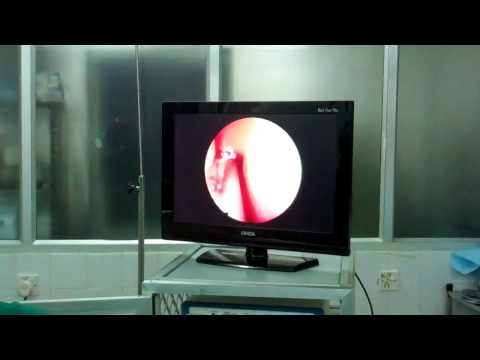 Nasal Polyp Removal by Microdebrider Instrument in India