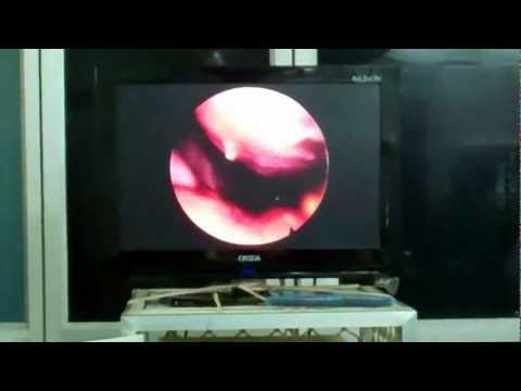 Nasal Polyps Can Cause Snoring