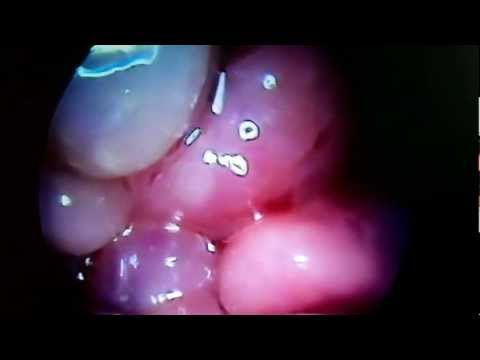 Nasal Polyps: Recurrence and Treatment