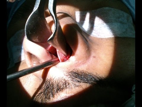 Nasal Septal Deviation-How Septoplasty Operation Done?