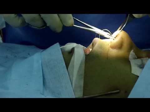Nasal Septal Perforation-Closure Technique