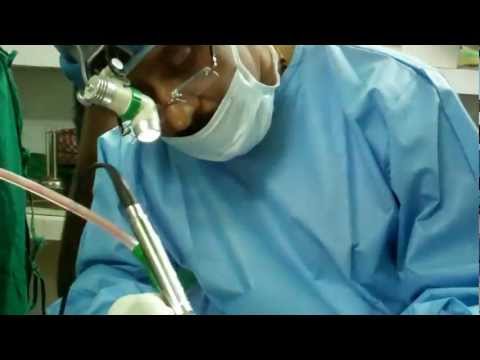 Nasal Surgery in India (Microdebrider)