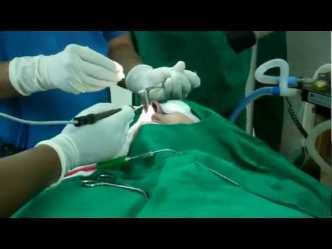 Nasal Surgery:SMD for nasal blockage
