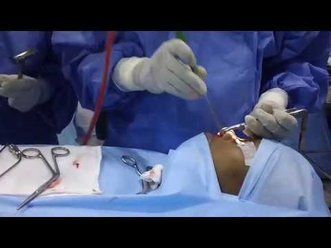 Nasal Surgery to Cure Bad Breath