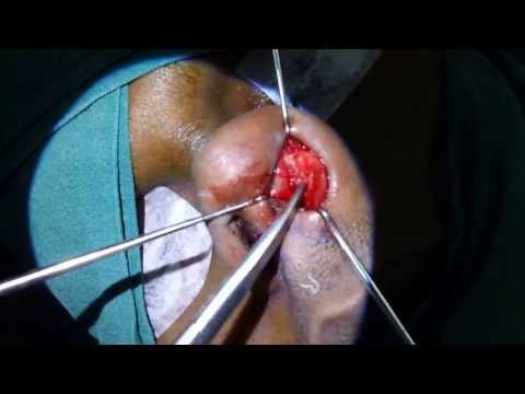 Nasal Tip Rhinoplasty in Trivandrum India