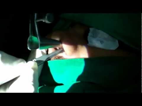 Nasal Valve Repair:For Nasal Blockage and Snoring