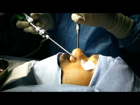 No Sense of Smell (Anosmia) Sense-less Life