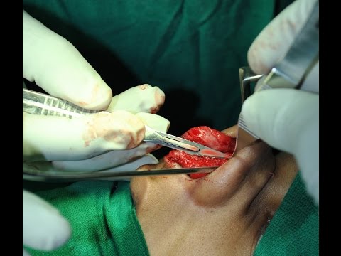 Nose Deformity Corrected by Rhinoplasty