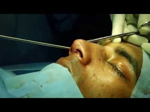 Nose Job-Open Rhinoplasty