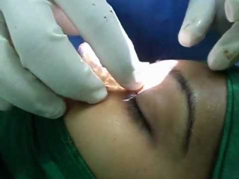 Nose Job-Rhinoplasty in India-2-Jubilee Hosital, Trivandrum..AVI