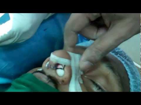 Nose-Low Cost Rhinoplasty in Kerala India