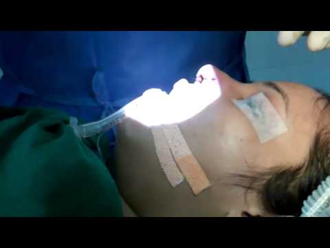 Nose Piercing After Rhinoplasty