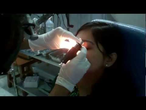 Nose Piercing in Surgical Clinic in India:Trivandrum