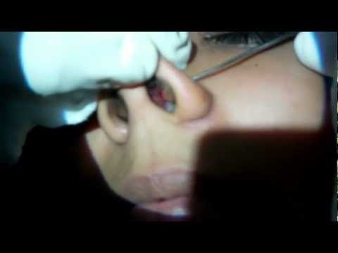 Nose Piercing In Trivandrum:Procedure