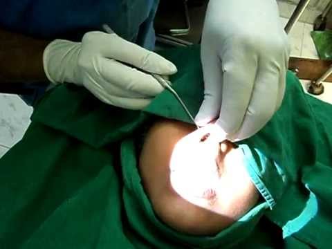 Nose piercing Surgically-Jubilee Hospital, Trivandrum, Kerala South India.