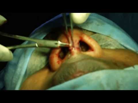 Nose Reshaping-Aesthetic Rhinoplasty in Kerala India