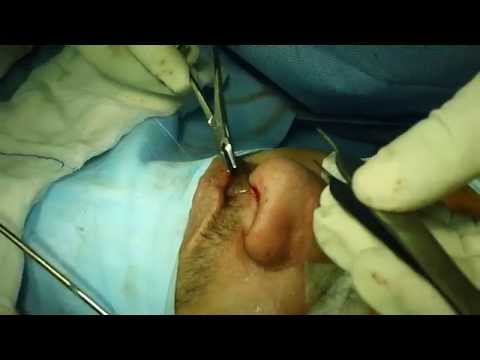 Nose Reshaping-Cosmetic Rhinoplasty