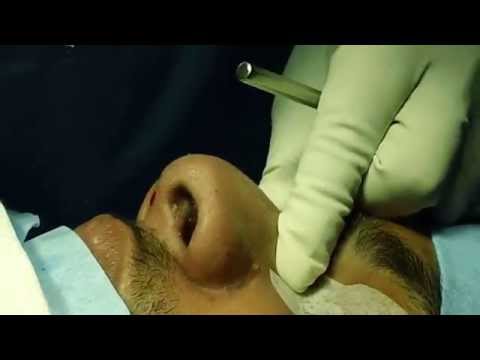 Nose Reshaping (Rhinoplasty) Planning before the Operation