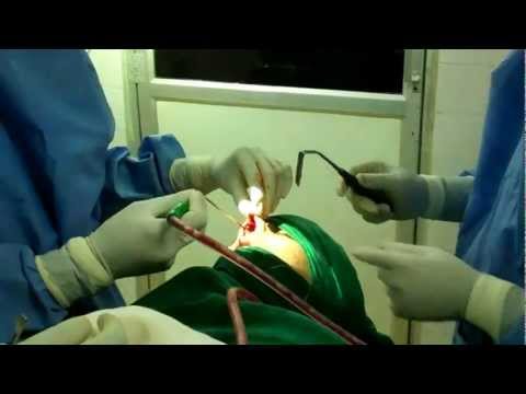 Open Rhinoplasty and Septoplasty in India