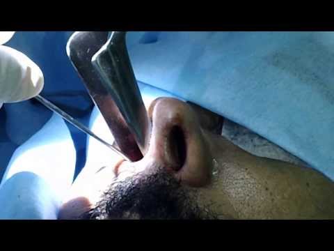 Over Use Of Nasal Drops-Rhinitis Medicamentosa-Treatment