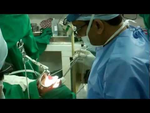 Painless Tonsillectomy in Children:Jubilee Hospital, Trivandrum