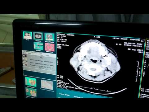Parotid Gland Tumor:CT Scan findings