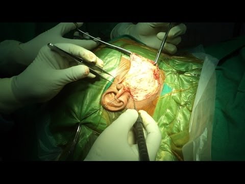 Parotid Salivary Gland Tumor Surgery In India