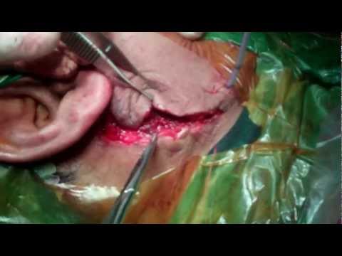 Parotid Tumor Surgery In Trivandrum, South India