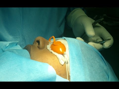 Patients Wakes After Nose Surgery