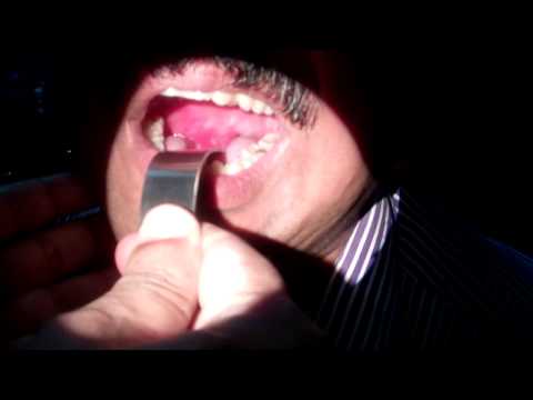 Peri tonsillar Abscess:Quinsy