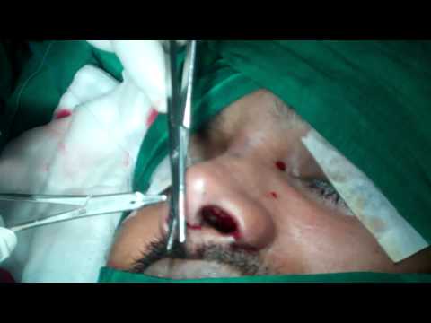Plastic Surgery of Nose (Rhinoplasty) in Kerala,India.