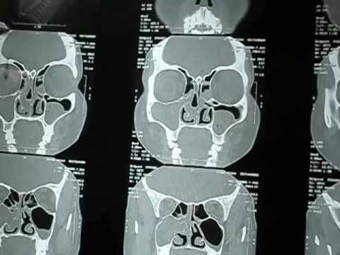 Pre Op Evaluation of Sinus Surgery.AVI.